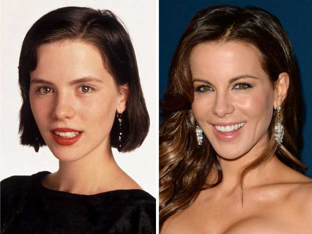 Did Kate Beckinsale Really Have The Plastic Surgery?