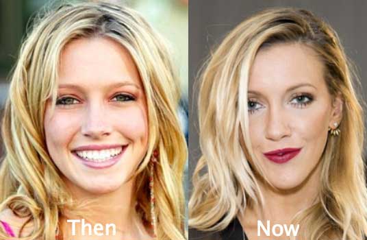 Katie Cassidy, The Actress Who Got Obsessed With The Cosmetic Surgery