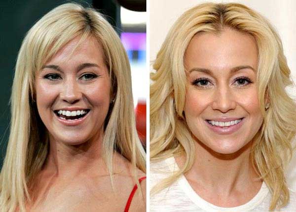 Kellie Pickles Plastic Surgery Scandals – The Actress Managed To Get Beauty Enhancement